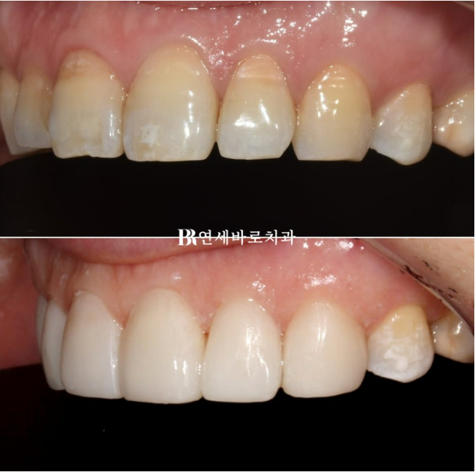 무삭제 라미네이트 아무곳에서 하지 마세요. 관련 이미지 5