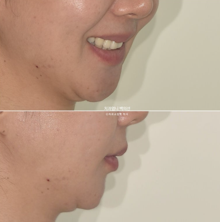 옥니 교정 역교정 재교정 무턱교정 치료기간 1년 10개월 관련 이미지 7