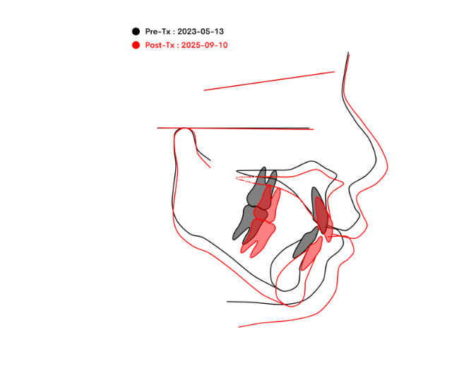 어린이 무턱 성장교정 덧니 인비절라인 퍼스트 악궁확장 치료기간 2년 관련 이미지 32