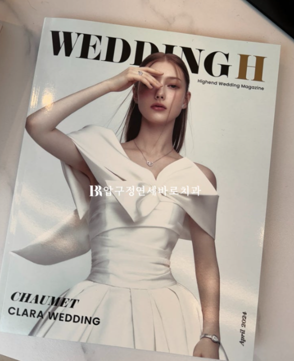 예비신부 교정 단기 앞니 부분교정 치료기간 6개월 관련 이미지 1