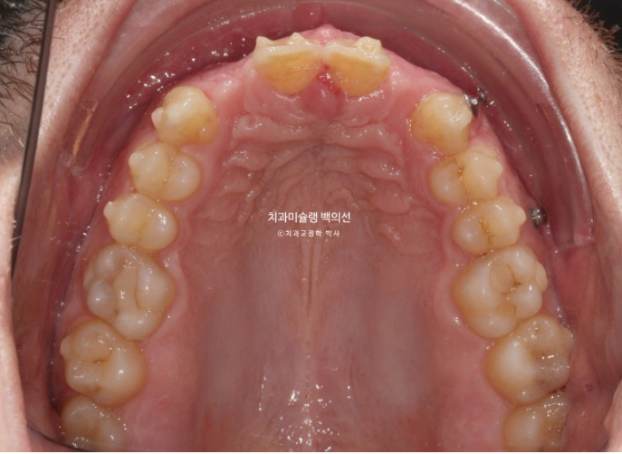앞니 선천적 결손 인비절라인 임플란트 과개교합 치료 기간 관련 이미지 13