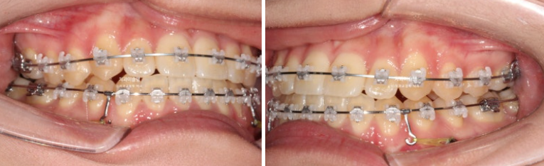 비발치 비수술 주걱턱 반대교합 재교정 치료 관련 이미지 7