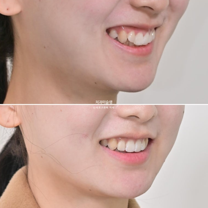 덧니 인비절라인 라이트 잇몸미소 거미스마일 중심선 블랙트라이앵글 관련 이미지 21