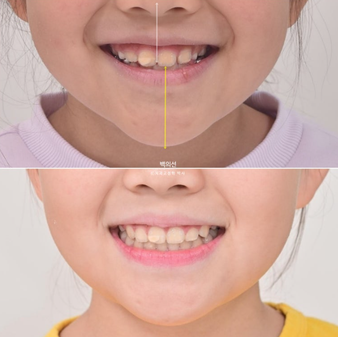 소아 비대칭 교정 인비절라인 퍼스트 재제작 1회 MA 치료 관련 이미지 15