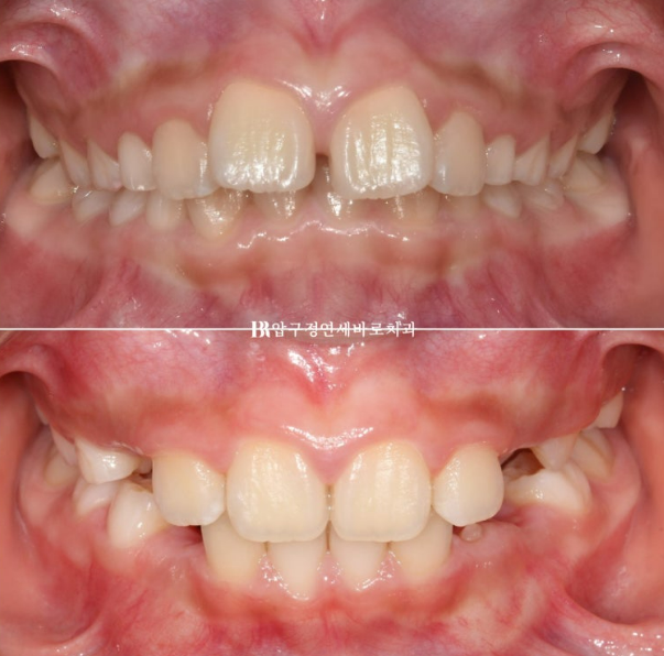 Invisalign First Correction for a Retruded Chin in a Child Orthodontic Treatment for Protrusion image 1