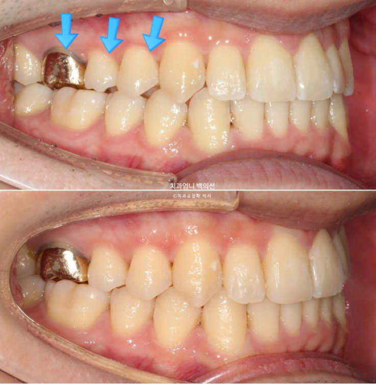 인비절라인 비발치 앞니 돌출 교정 치료기간 2년 5개월 관련 이미지 12