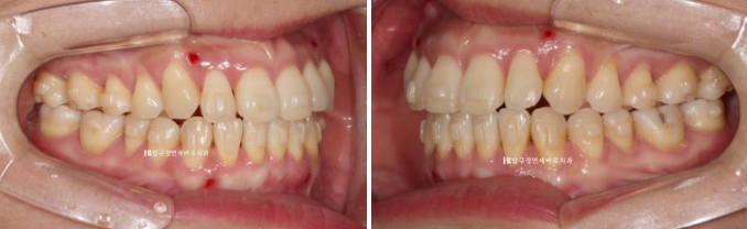 양악수술 선수술 교정 후기 인비절라인 교정 관련 이미지 7