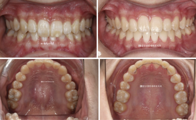 옥니교정 / 웃을때 아랫니만 보여요. 앞니 노출도 교정? 관련 이미지 9
