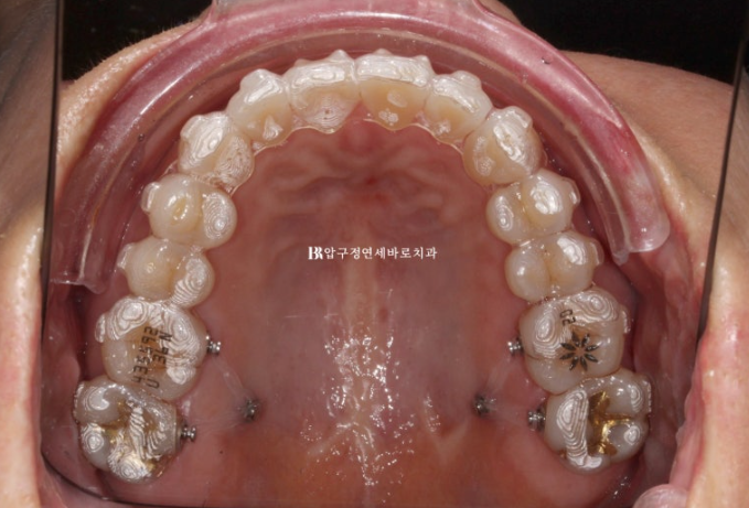 50대 인비절라인 개방교합 합입교정 미니스크류 관련 이미지 4