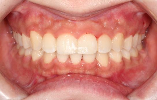 Inward-Tilted Teeth Orthodontic Treatment Review | A Real Case of Treating Congenitally Missing Lower Incisor (Three Lower Front Teeth) Without Extractions image 8