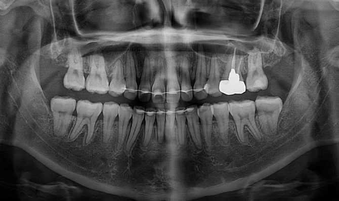Gummy Smile Correction, Gummy Smile Orthodontics, Rabbit Teeth Correction image 20
