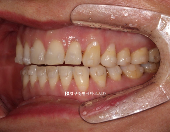 50대 인비절라인 개방교합 합입교정 미니스크류 관련 이미지 12