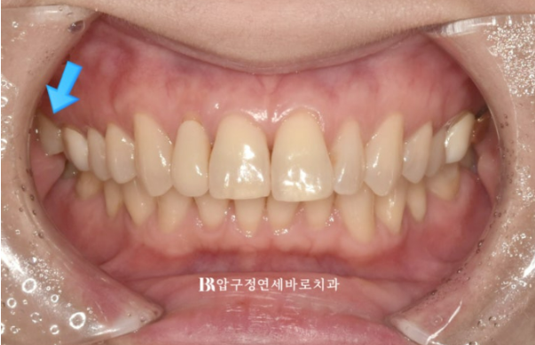 Can Invisalign Lite Work for Patients in Their 40s? A Real Case Improving Scissor Bite and Deep Bite in 10 Months image 3
