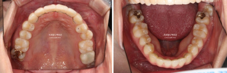 앞니 부분 교정 급속 교정 토끼이빨 MTA 미니튜브 치간삭제 치료기간 9개월 관련 이미지 12