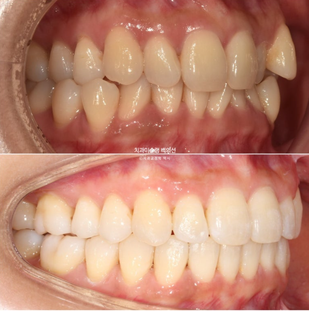 옥니 덧니 과개교합 반대교합 중심선 인비절라인 치료기간 1년 관련 이미지 15
