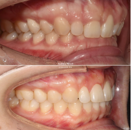 Inward-Tilted Teeth Orthodontic Treatment Review | Actual Case Improved with Non-Extraction Orthodontic Treatment for Gummy Smile, Deep Overbite & Gum Asymmetry — Gangnam Orthodontic Clinic image 15