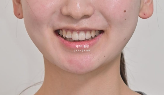 덧니 인비절라인 라이트 잇몸미소 거미스마일 중심선 블랙트라이앵글 관련 이미지 11