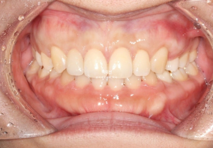 30대 치아교정 돌출입 교정 :: 잇몸미소 거미스마일 교정 입술부전증 결손치 무턱교정 관련 이미지 13