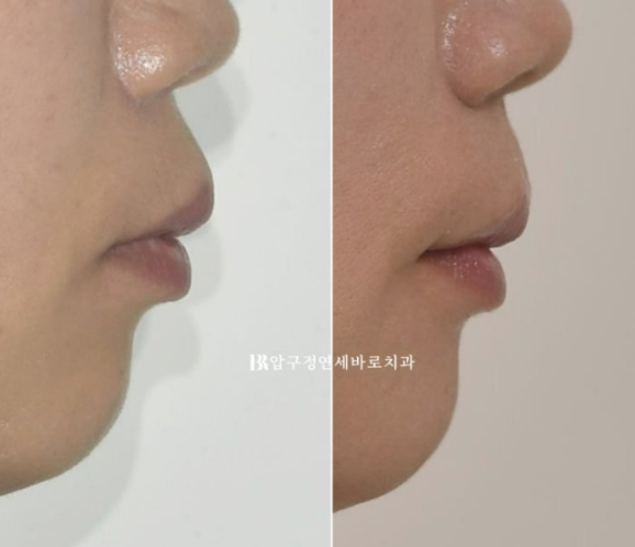 40대 치아교정 가능할까요? 치주염 있어도 치아교정 가능할까요? 임플란트 없이 교정하기 관련 이미지 14