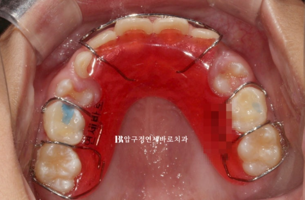 어린이 주걱턱 교정, 만 8세 앞니 반대교합을 페이스마스크로 치료한 사례 관련 이미지 11