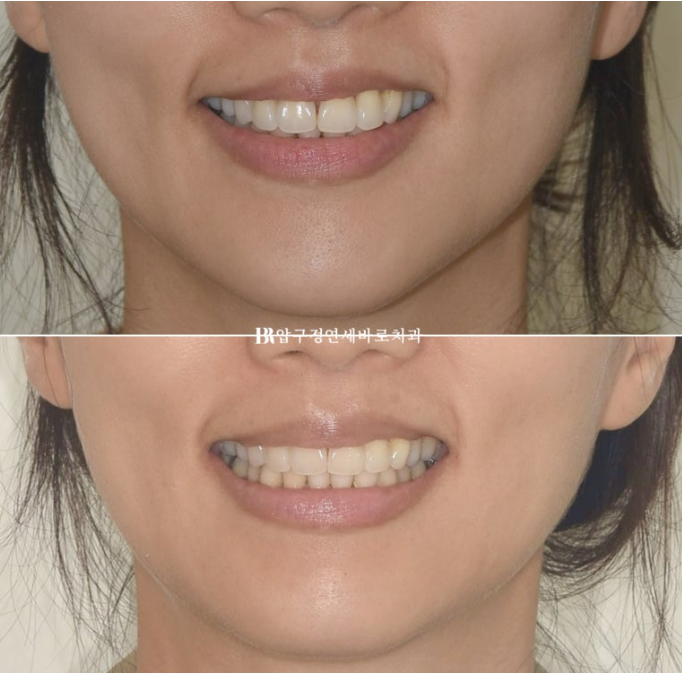 How Can Black Triangles Be Removed? Is Re-treatment Orthodontics an Option? image 11