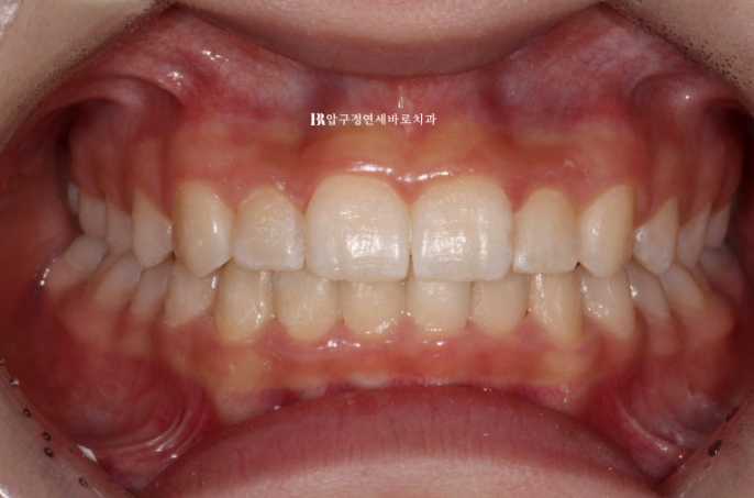 인비절라인라이트 덧니 과개교합 교정 치료기간 9개월 관련 이미지 9