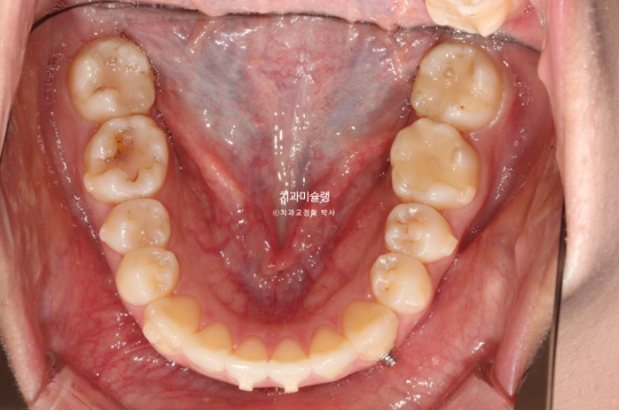 인비절라인 라이트 반대교합? 덧니 중심선 치간삭제 치료 관련 이미지 10