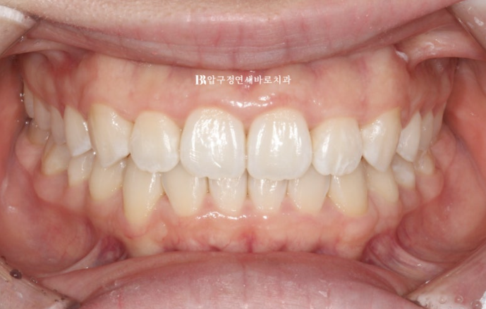 인비절라인 라이트 과개교합 반대교합 돌출입 뻐드렁니 교정 치료 관련 이미지 12