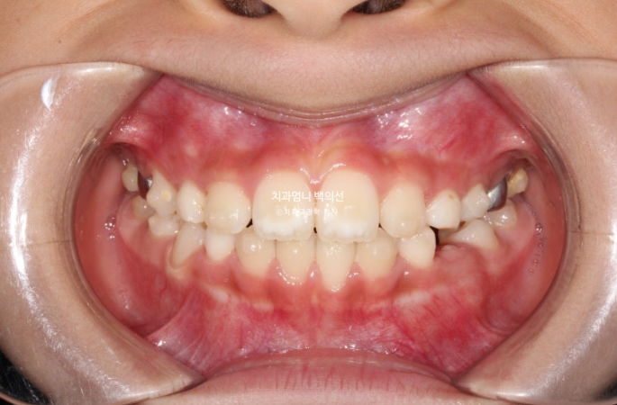 어린이 교정 인비절라인 퍼스트 비대칭 반대교합 어린이 성장 교정 관련 이미지 13