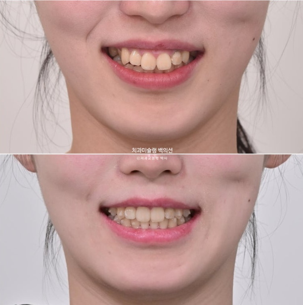 잇몸미소 인비절라인 거미스마일 토끼이빨 교정 무삭제 라미네이트 반대교합 치료 후기 관련 이미지 11