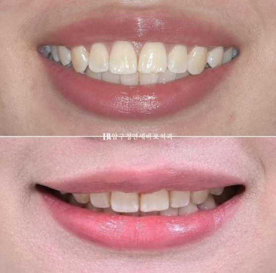 돌출입 교정 입동굴 클리피씨 교정 후기 관련 이미지 13