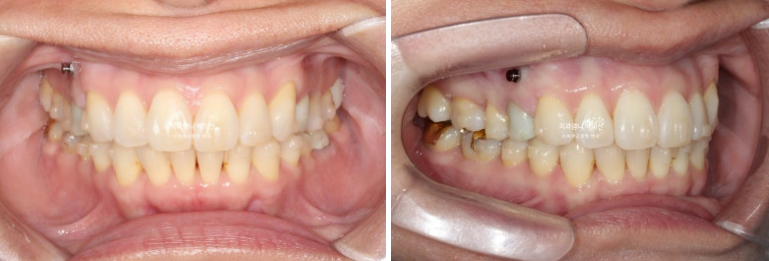 50대 치아교정 교합평면 기울어짐 토끼이 덧니 교정? 관련 이미지 5