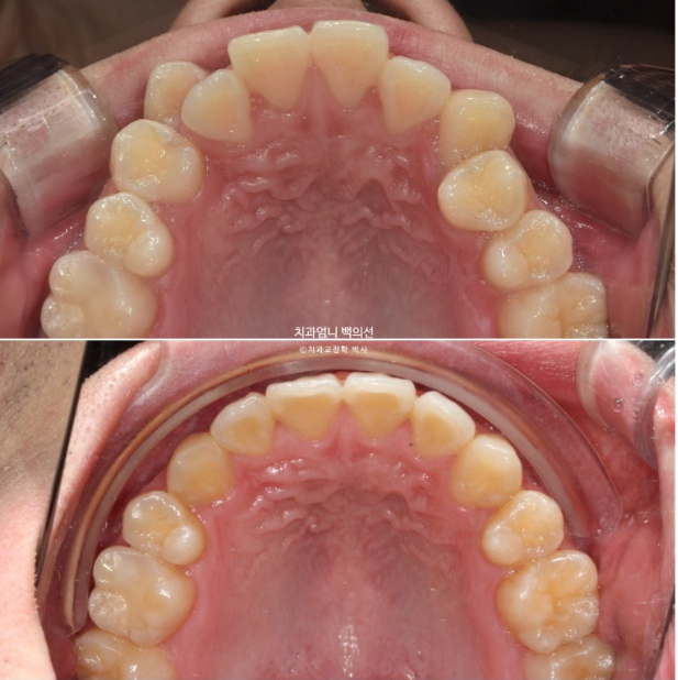 투명교정 인비절라인 덧니 교정 치료기간 알아보기 관련 이미지 14