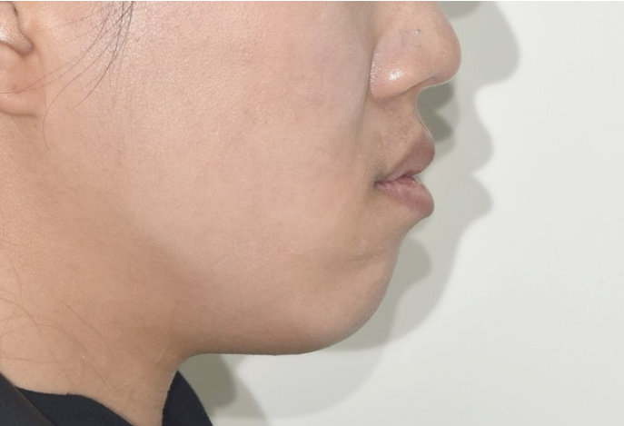 거미스마일 교정 돌출입 발치교정 입술부전 호두턱 치료기간 2년반 관련 이미지 8