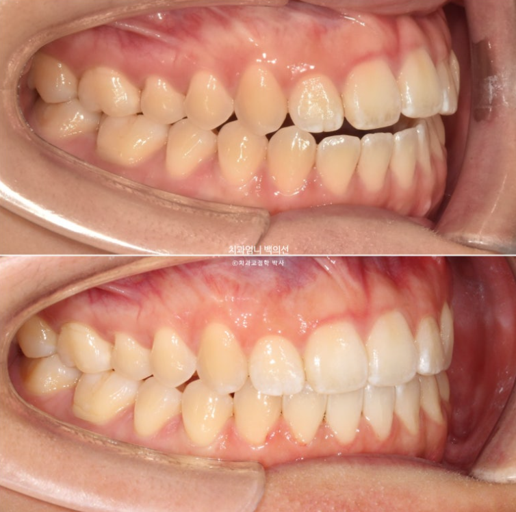 앞니 단기 부분교정 재교정 개방교합 교정 후기 관련 이미지 13