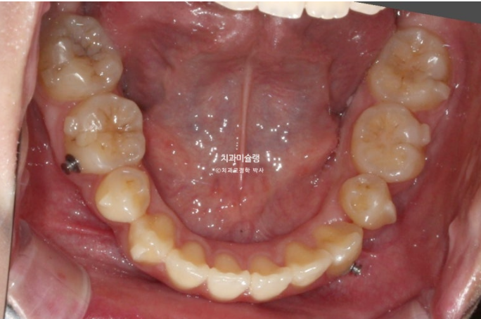 30대 인비절라인 덧니 발치교정 개방교합 치료 관련 이미지 12