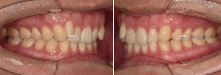 옥니 덧니 교정 왜소치 선천적 결손 3전치 무삭제 라미네이트 인비절라인 교정 관련 이미지 8