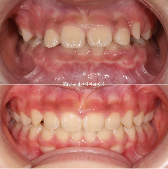 Pediatric Clear Aligners That Improved Both Deep Bite and Protruding Teeth image 15