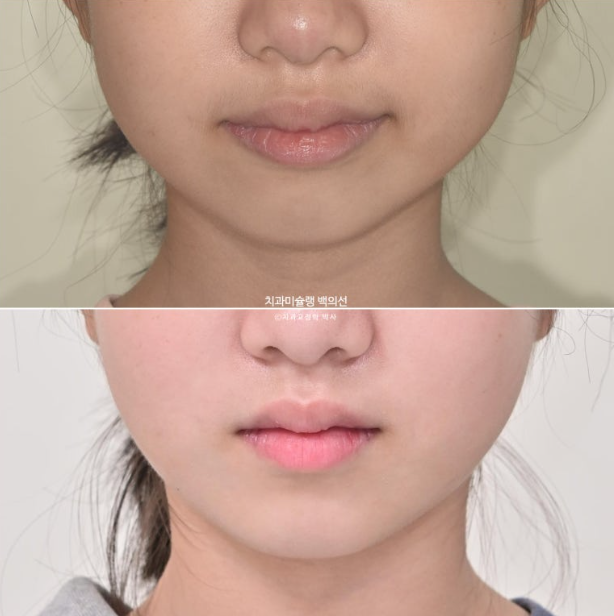 돌출입 무턱 인비절라인 발치교정 덧니 치료기간 1년 11개월 관련 이미지 14