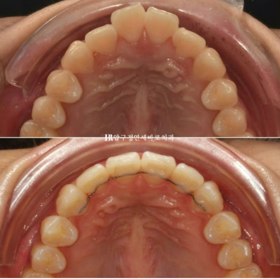 인비절라인 익스프레스 토끼이빨 앞니교정 ? 관련 이미지 1
