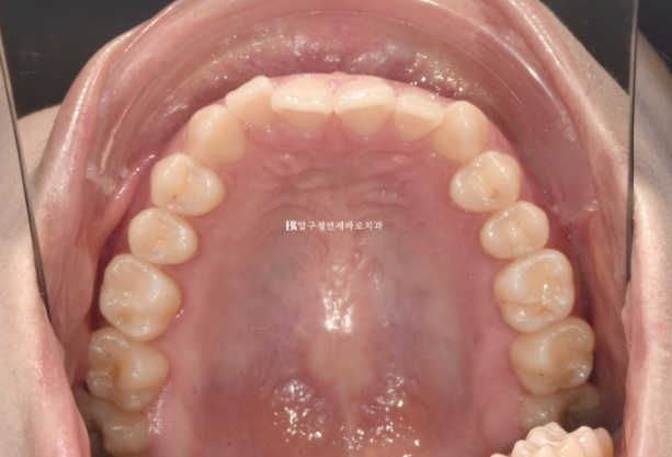 If Inward-Tilted Teeth Make Your Smile Look Constricted? Invisalign Before and After image 4