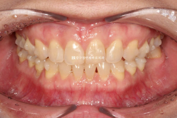 Can Gaps Between the Front Teeth Be Treated with No-Prep Veneers Alone? A Real Case Completed with Gelami After Invisalign Lite image 8