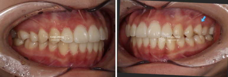 앞니 부분 교정 급속 교정 토끼이빨 MTA 미니튜브 치간삭제 치료기간 9개월 관련 이미지 11