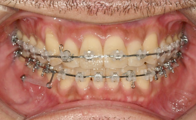 30대 MSE 악궁확장 덧니 반대교합 비발치 클리피씨 부작용 관련 이미지 12