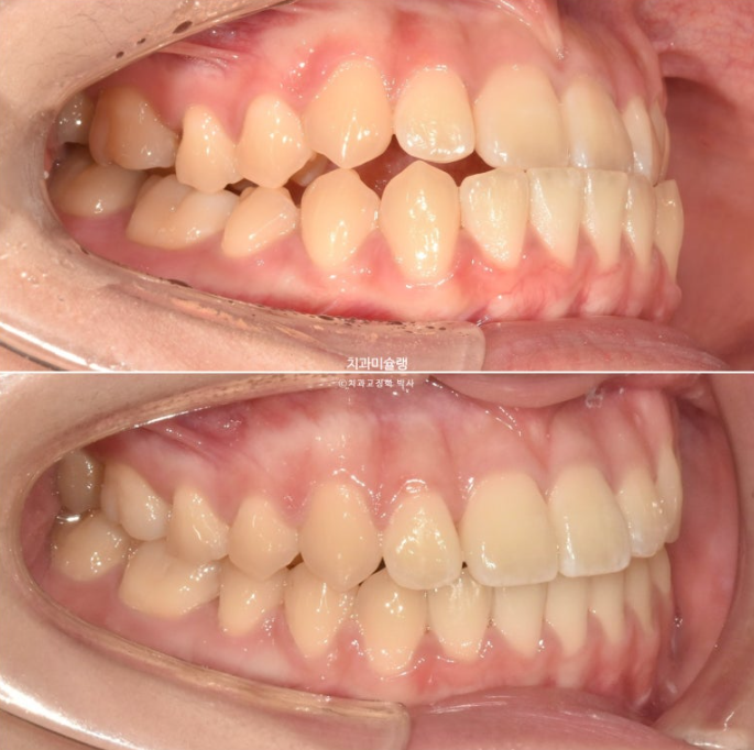 비발치 비수술 주걱턱 반대교합 재교정 치료 관련 이미지 14