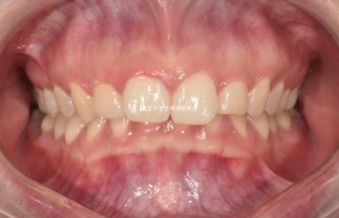 인비절라인 돌출입 발치교정 거미스마일 잇몸미소 교정 관련 이미지 1