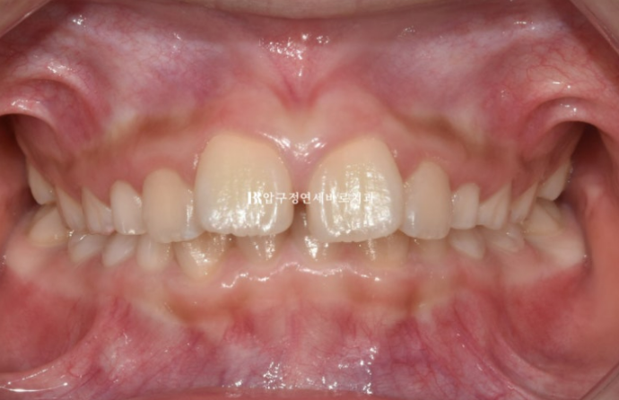 무턱교정 어린이 투명교정 인비절라인 퍼스트 교정 후기 관련 이미지 2