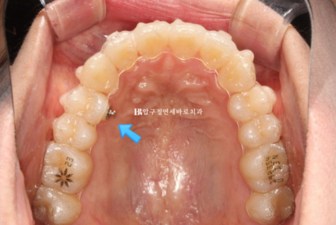 Invisalign Lite Treatment for Crossbite, Rabbit Teeth, and Protruding Front Teeth Correction image 6