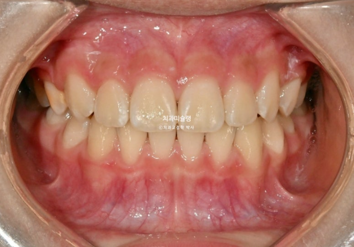 어린이 돌출입 교정 무턱 투명교정 인비절라인 퍼스트 관련 이미지 15