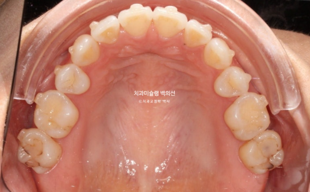 인비절라인 익스프레스 재교정 블랙트라이앵글 치간 삭제 치료기간 6개월 재제작 1회 관련 이미지 8